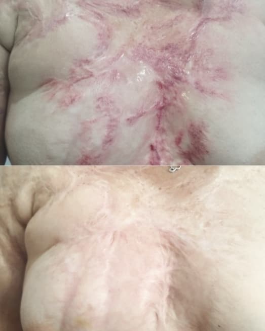 Correção de Cicatrizes